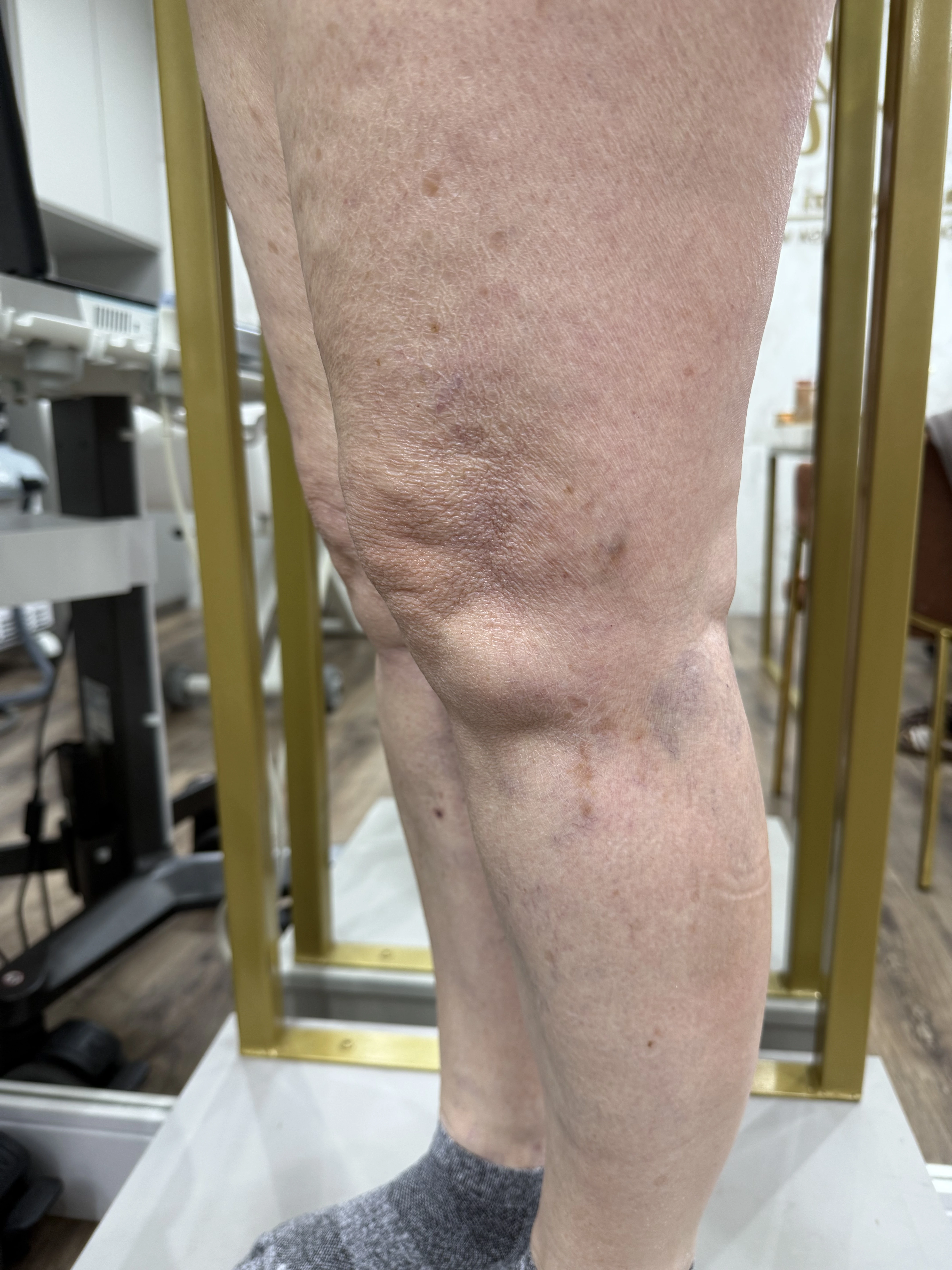 Pernas depois do tratamento Espuma + Laser Transdérmico + Escleroterapia